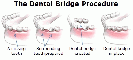 The Dental Bridge Procedure