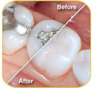 White Fillings Before and AFter