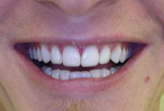Cosmetic bonding provided by Bethesda dentist Dr. David Mazza, DDS
