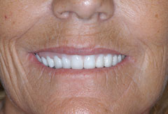 Full Mouth Implant Bridge provided by Bethesda dentist Dr. David Mazza, DDS