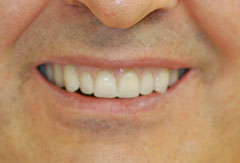 Upper Jaw Implant Bridge provided by Bethesda dentist Dr. David Mazza, DDS