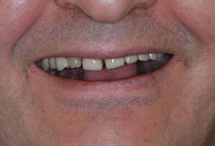 Upper Jaw Implant Bridge provided by Bethesda dentist Dr. David Mazza, DDS
