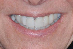 Crowns and Bridges provided by Bethesda dentist Dr. David Mazza, DDS