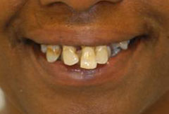 Dentures provided by Bethesda dentist Dr. David Mazza, DDS