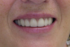 Dentures provided by Bethesda dentist Dr. David Mazza, DDS