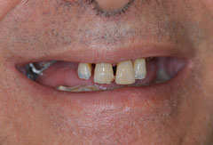 Bonding and Implant Supported Denture provided by Bethesda dentist Dr. David Mazza, DDS