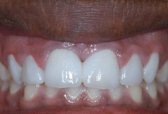 Crowns and Bridges provided by Bethesda dentist Dr. David Mazza, DDS