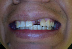Gum treatment provided by Bethesda dentist Dr. David Mazza, DDS