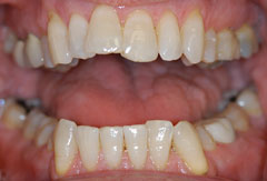Gum treatment provided by Bethesda dentist Dr. David Mazza, DDS