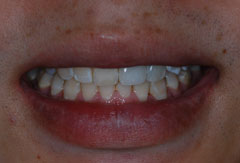 Implant provided by Bethesda dentist Dr. David Mazza, DDS