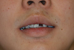 Implant provided by Bethesda dentist Dr. David Mazza, DDS