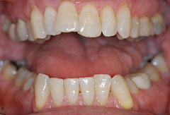 Invisalign provided by Bethesda dentist Dr. David Mazza, DDS