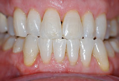 Invisalign provided by Bethesda dentist Dr. David Mazza, DDS