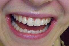 Teeth Whitening provided by Bethesda dentist Dr. David Mazza, DDS