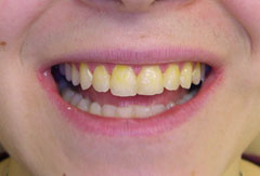 Teeth Whitening provided by Bethesda dentist Dr. David Mazza, DDS