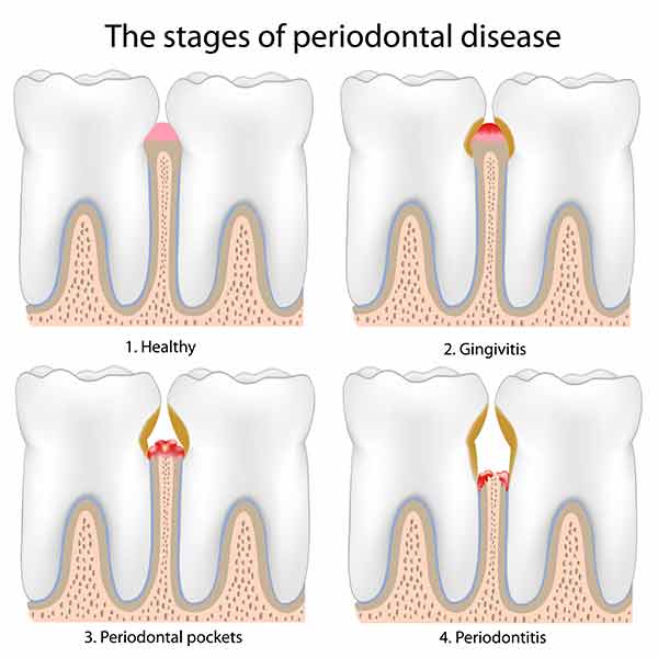 The Stages of Gum Disease